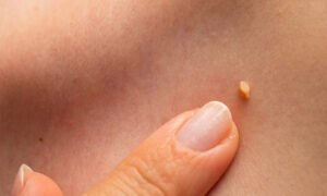 激光嫩膚與去疣療程 Laser Skin & Mole Removal