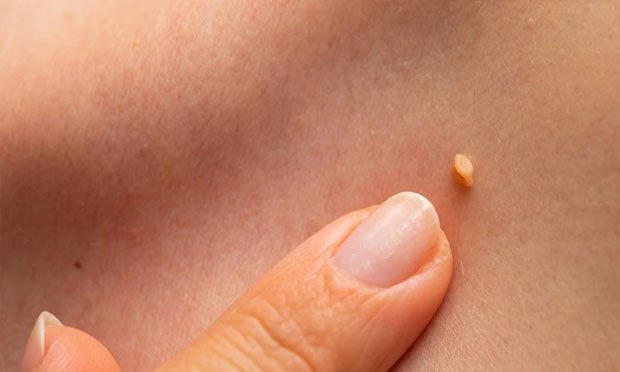 激光嫩膚與去疣療程 Laser Skin & Mole Removal